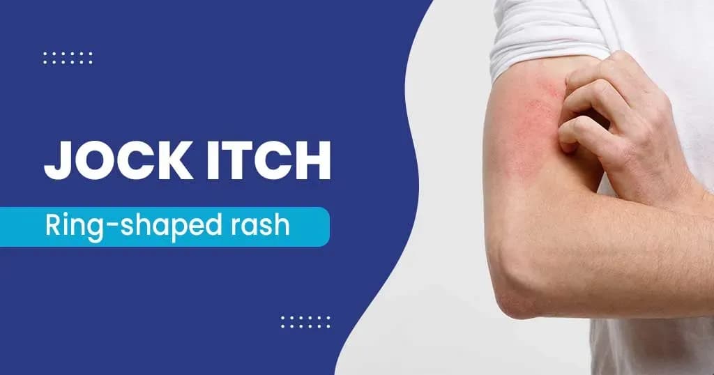 Jock Itch 