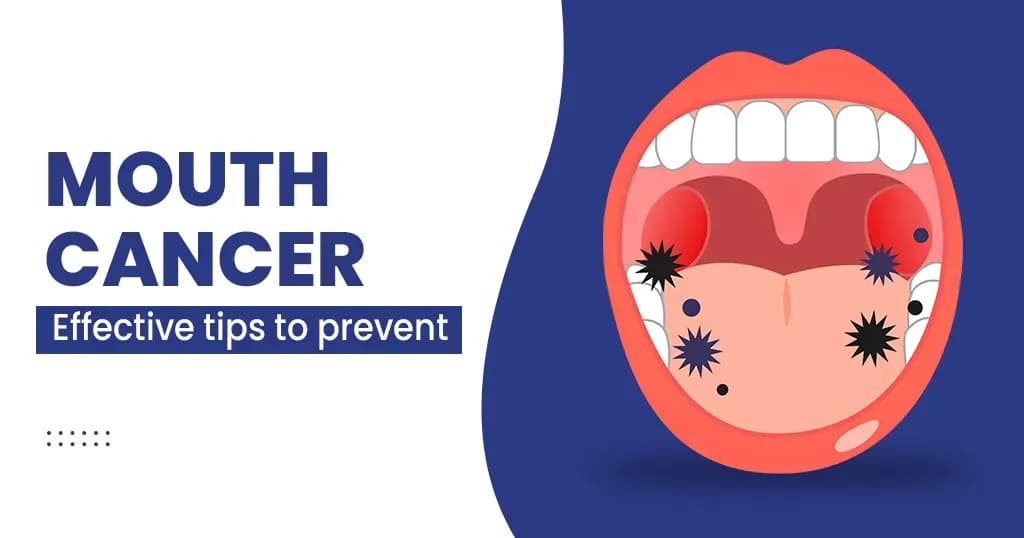 Mouth Cancer Symptoms, Causes and Treatments