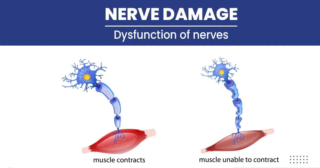 Nerve Damage Types, Symptoms, Causes, and Treatments 