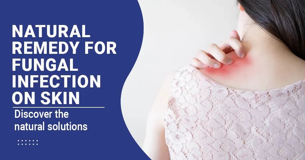 15 Remedies for Fungal Infection on Skin  