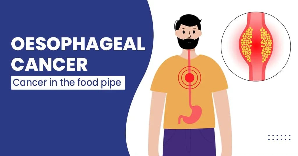 Oesophageal Cancer Types, Symptoms, Prevention and more