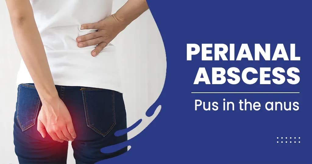 Perianal Abscess Causes, Symptoms, Risk Factors, and Treatments