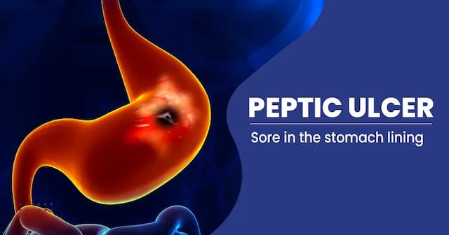 Peptic Ulcer Disease  Causes, Symptoms, Treatment and Preventions  
