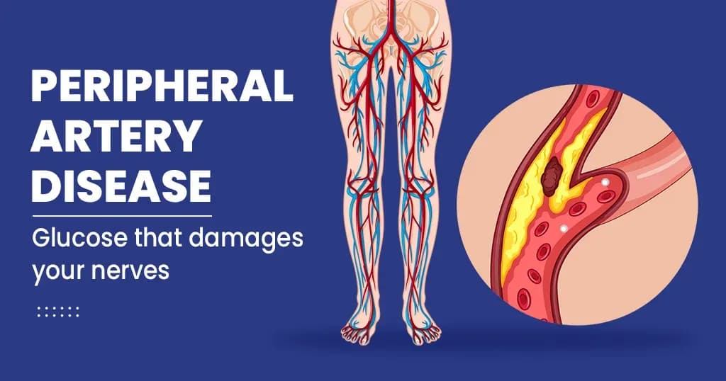 Peripheral Artery Diseases Risk, Symptoms, Diagnosis and Treatment