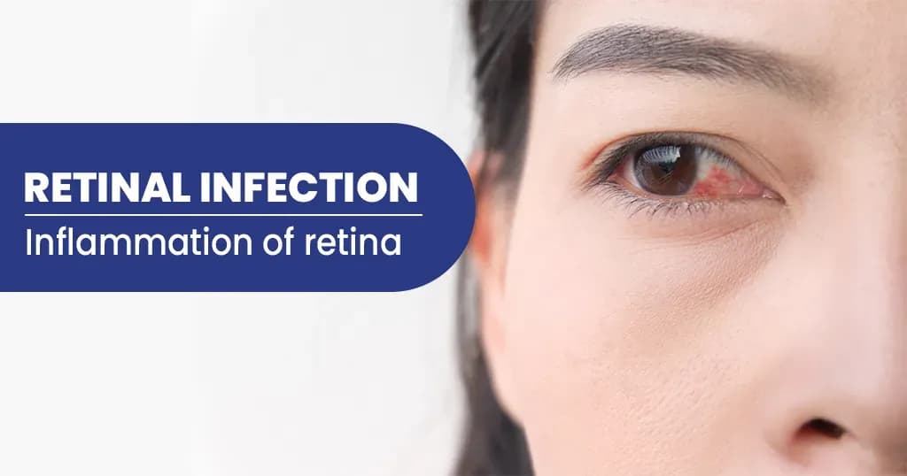 Retinal Infection Types, Symptoms, Risk factors, and Treatments  