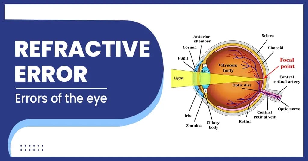 Refractive Errors 