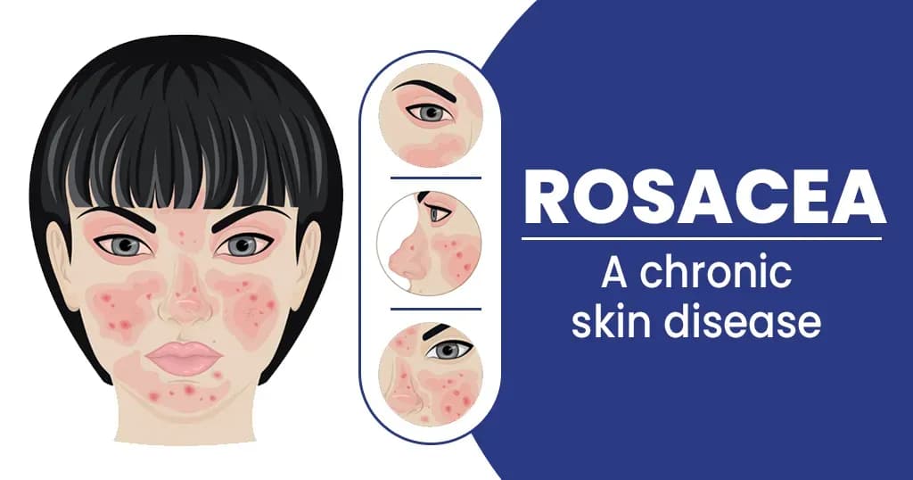 Rosacea Causes, Types, Symptoms and Treatments
