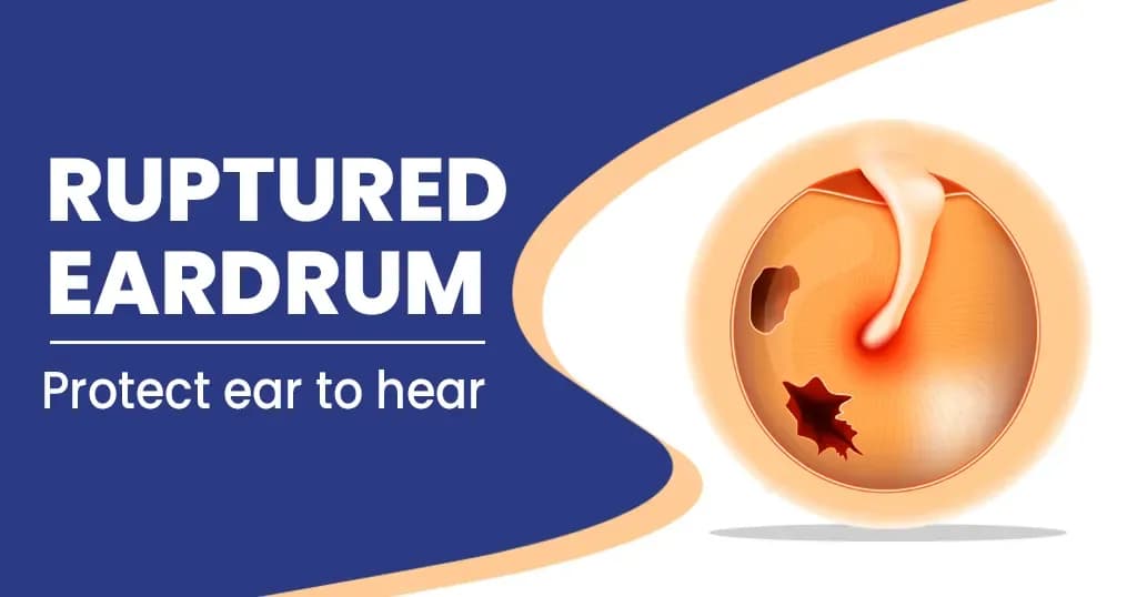 Ruptured Eardrum    