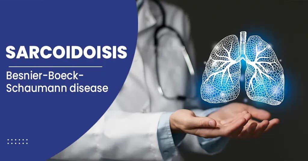 Sarcoidosis  Symptoms, Causes, Diagnosis, and Treatments 