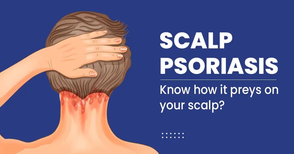 Scalp Psoriasis
