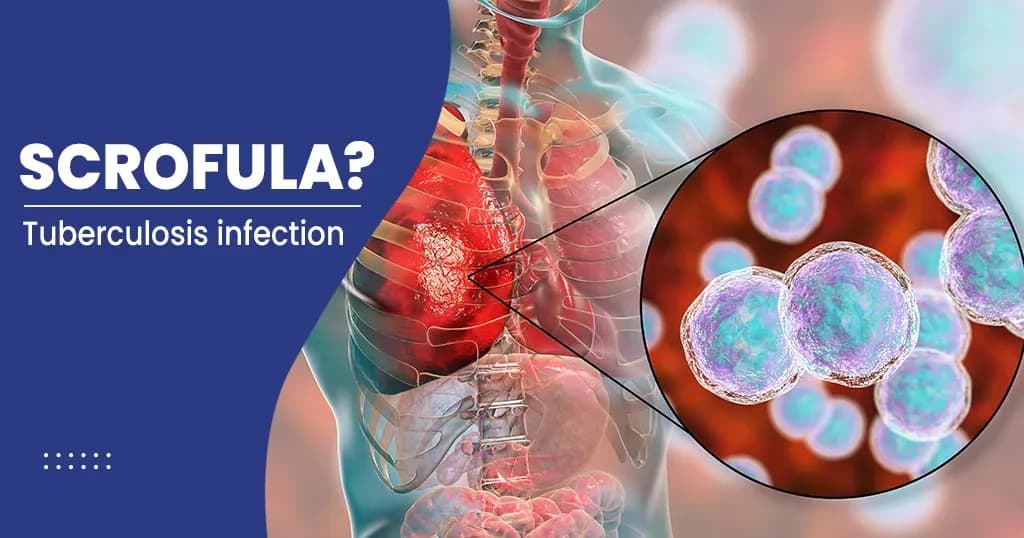 Scrofula Causes, Symptoms, Diagnosis, and Risk factors