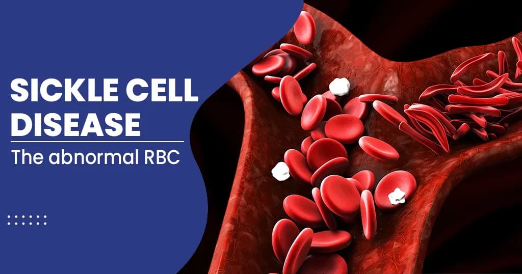 Sickle Cell Anemia  Types, Symptoms, Causes, and Treatments  