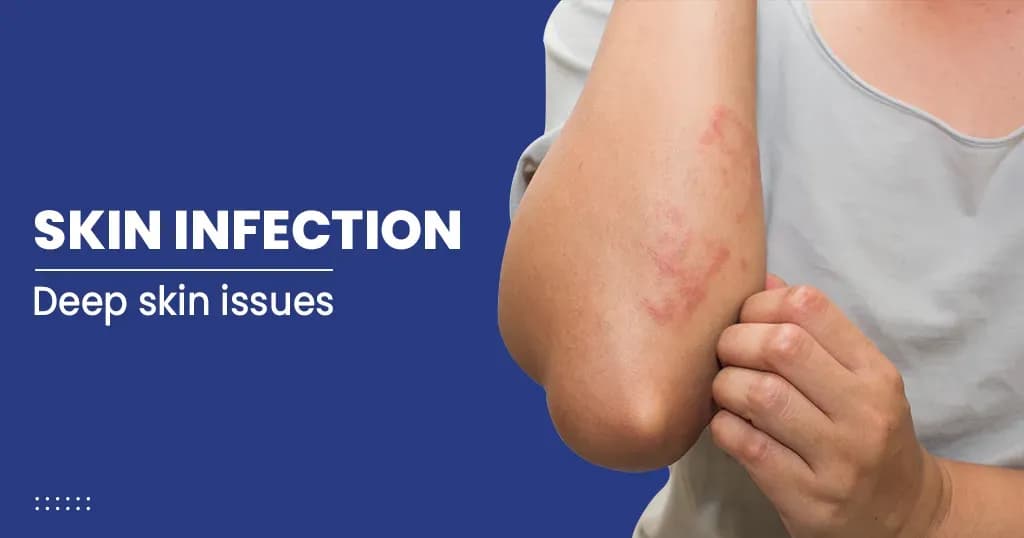 Skin Infection Causes, Symptoms, Treatments, and Risk factors