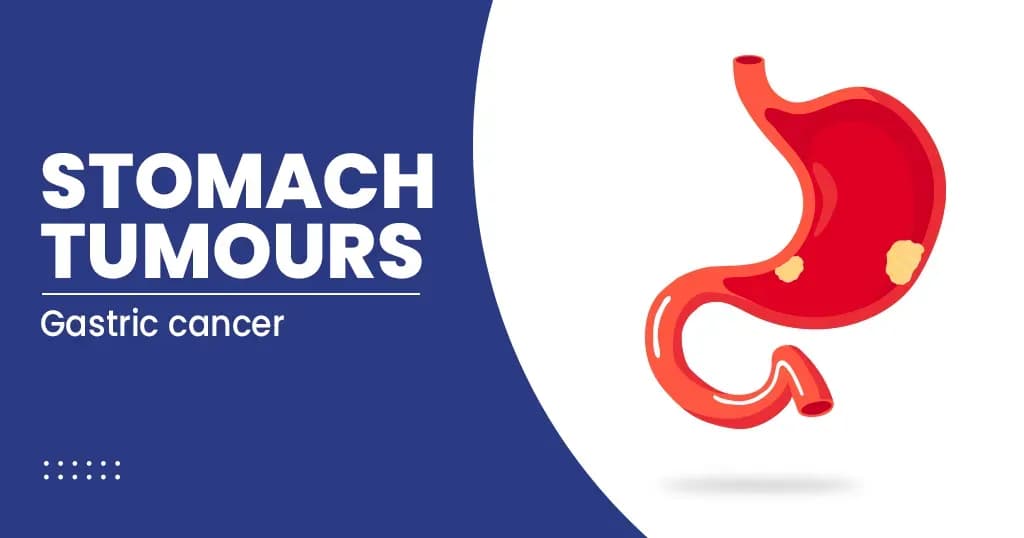 Stomach Tumours Symptoms, Diagnosis, and Treatment
 
 