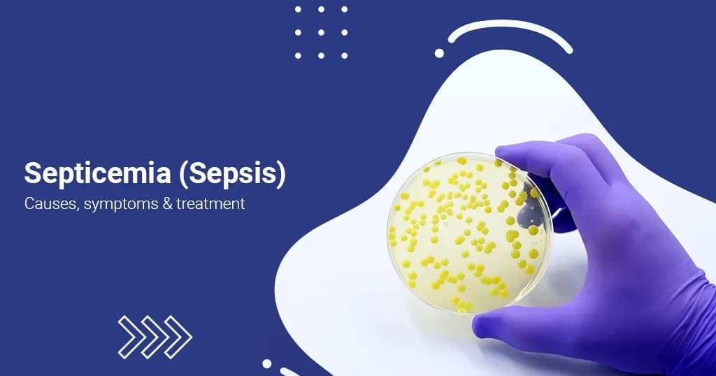 Septicemia Causes, Symptoms and Treatment  