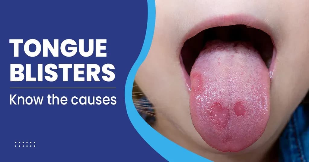 Tongue Blisters
