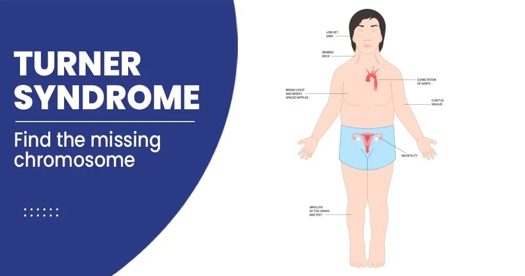 Turner’s Syndrome Types, Symptoms, Risk Factors, and Treatments    