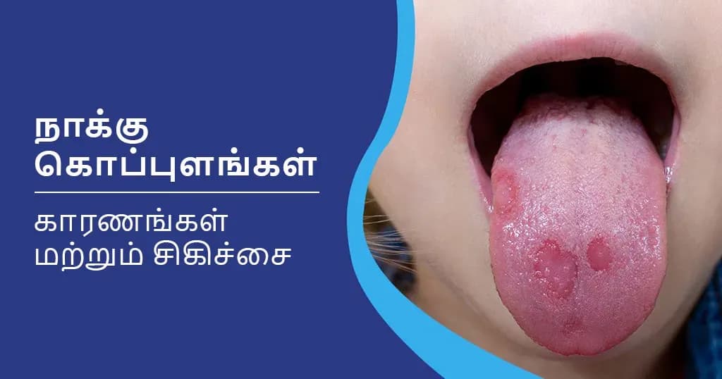 நாக்கில் ஏற்படும் கொப்புளங்கள் - அதற்கான காரணங்கள் மற்றும் சிகிச்சை