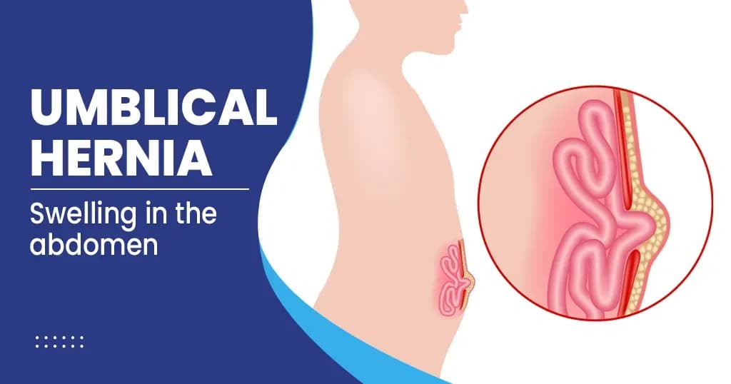 Umbilical Hernia Symptoms, Risk factors, and More