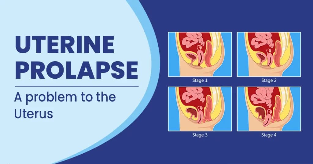 Uterine Prolapse Symptoms, Causes, Risks and Prevention 