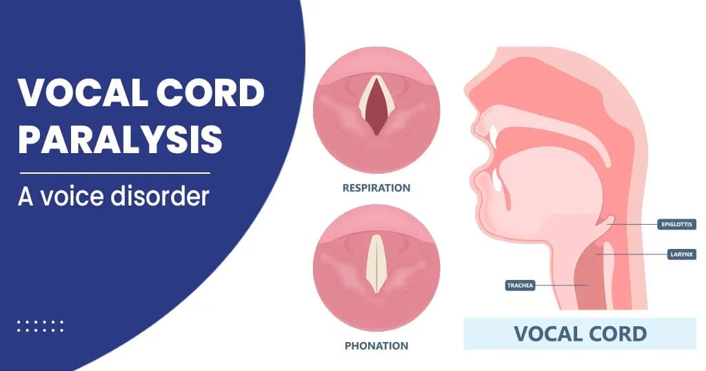 Vocal Cord Paralysis Symptoms, Causes , Treatments 