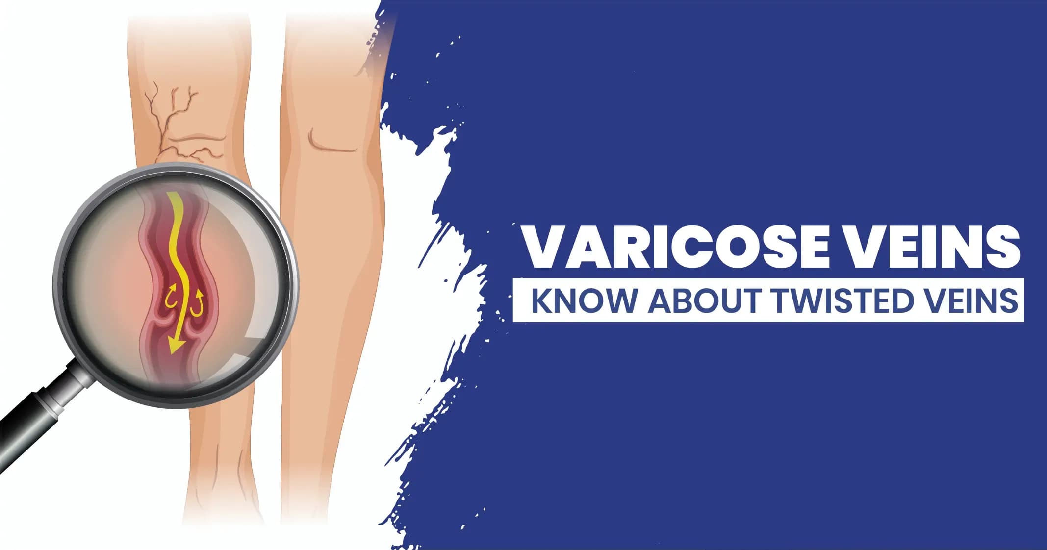 Varicose Veins Symptoms, Causes, Diagnosis and Treatment