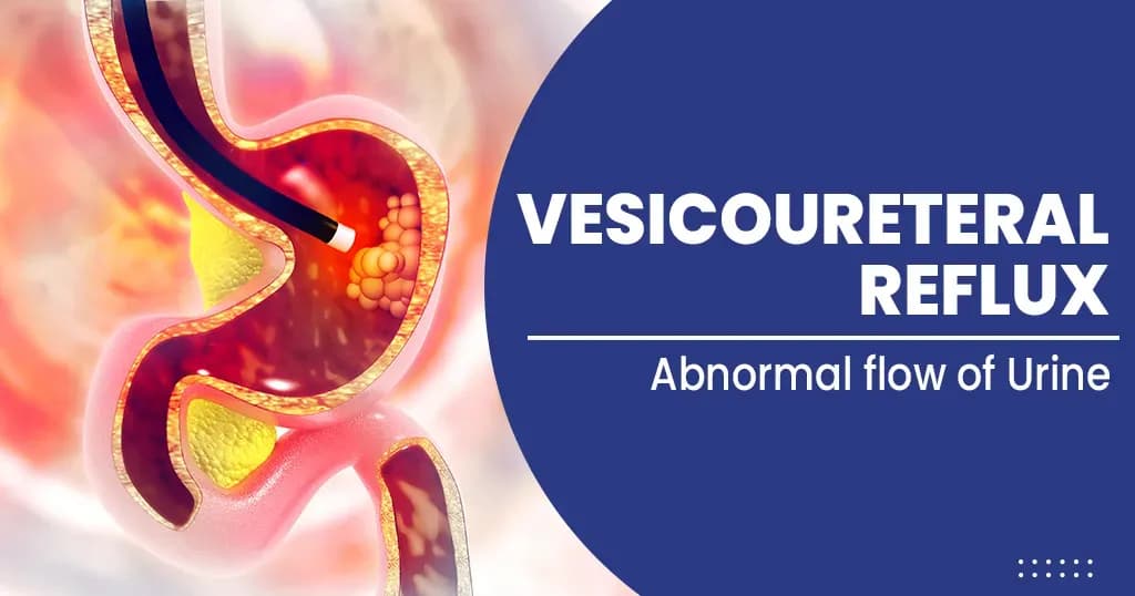 Vesicoureteral Reflux  Symptoms, Causes, Treatments and More    