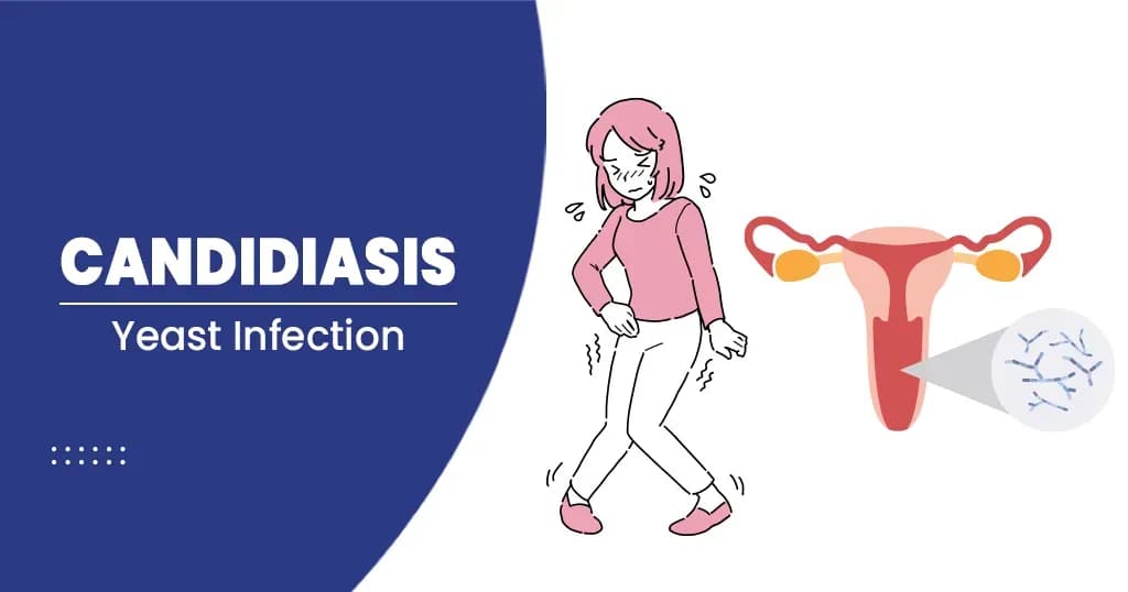 Yeast Infection Causes, Symptoms and Treatment