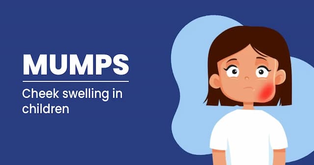 Mumps in Children - Easy to Prevent