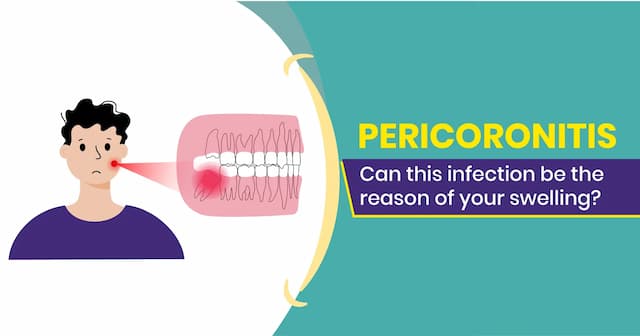 Pericoronitis Symptoms, Complications and Treatment 