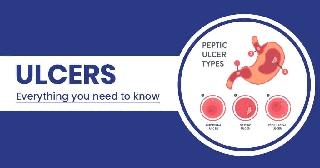 Different Types of Ulcers and Its Symptoms
