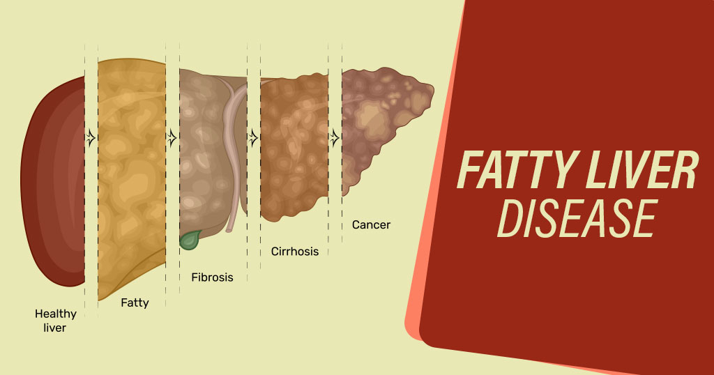 Fatty-Liver
