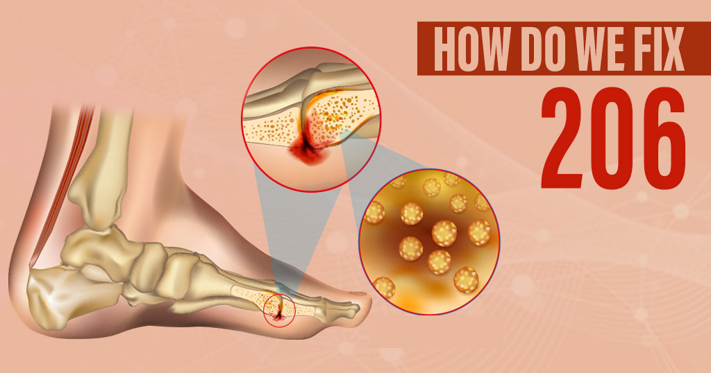 Bone Infection (Osteomyelitis)