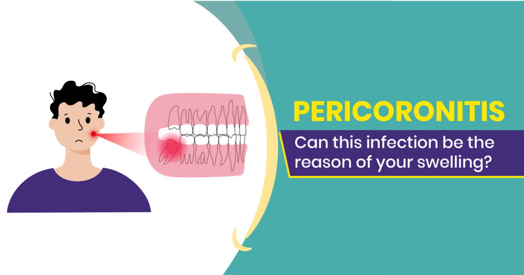Pericoronitis is when the gum gets swelled, inflamed and infected because of the bacteria built near the partially erupted molar. Pericoronitis can be prevented by following proper oral hygiene.
