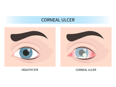Picture of ulcer in the eyes