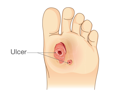 Ulcer on the foot