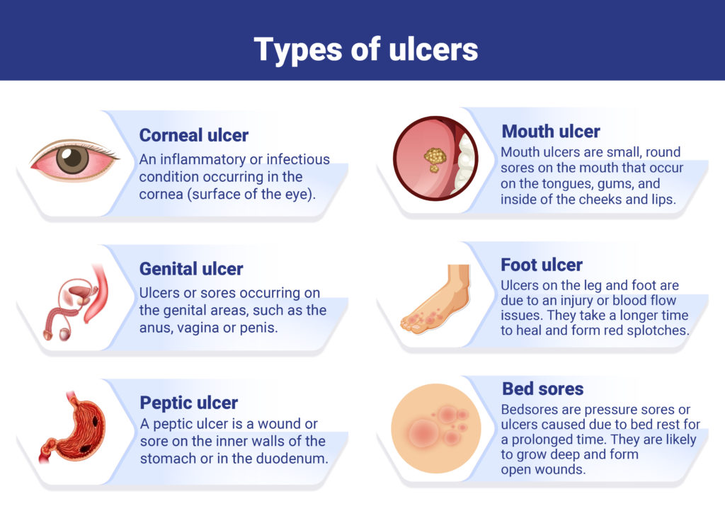 Various types of ulcers