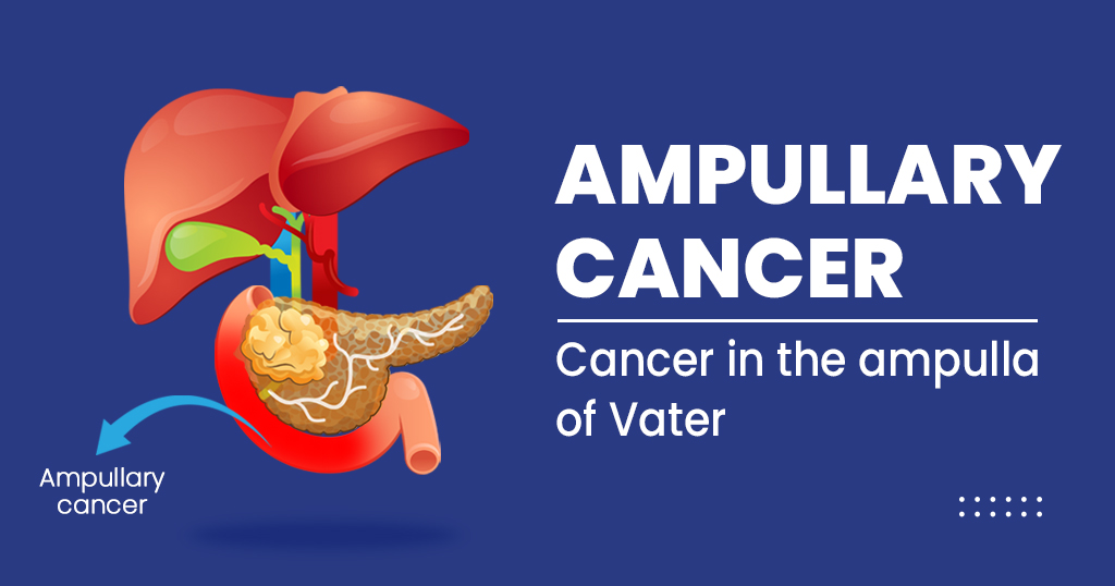 AMPULLARY CANCER