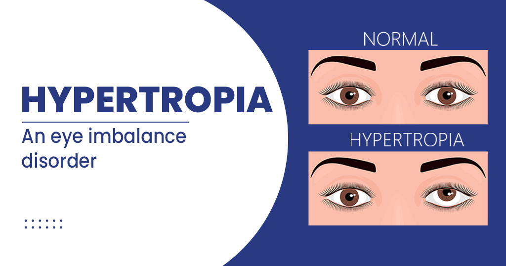 Hypertropia – Causes, Symptoms, Risk factors and more
