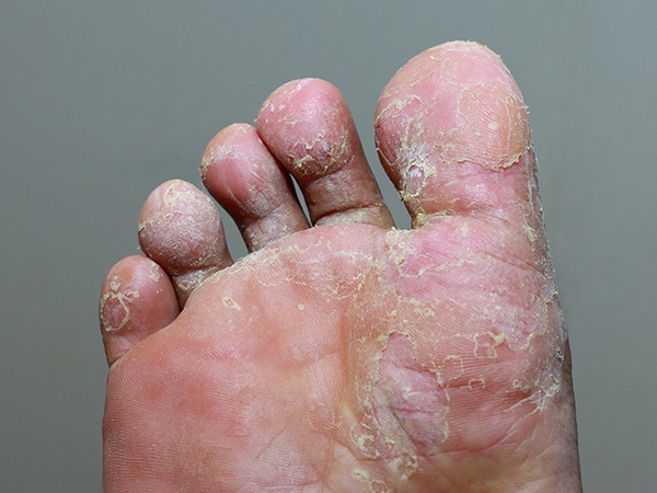 What does athlete's foot look like?