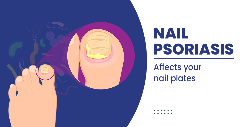 Nail psoriasis