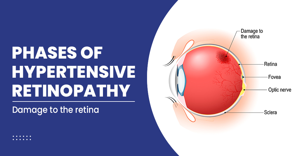 Phases of Hypertensive Retinopathy