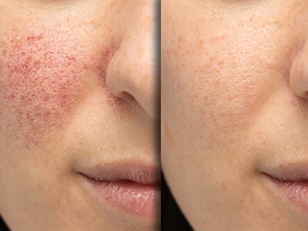 Before and after images of laser treatment