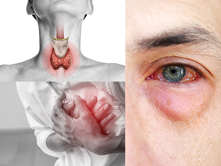 Stroke , eye injury ,and thyroid
