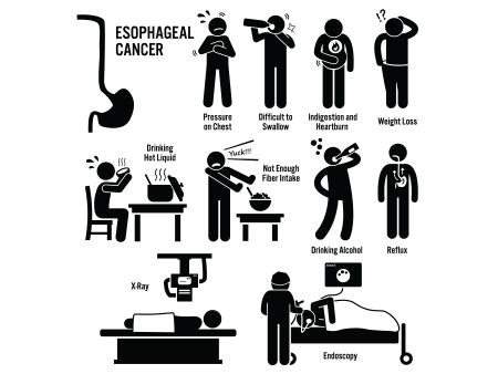 Preventions of Oesophageal cancer
