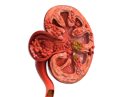 Kidney problems due to diabetes
