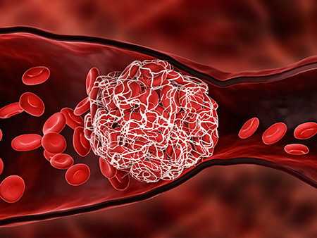 What is a blood clot?