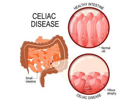 Celiac disease