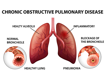 Symptoms of Lung Disease