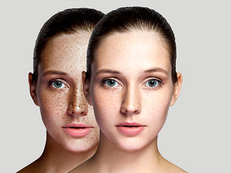 Skin disorders of melanin imbalance